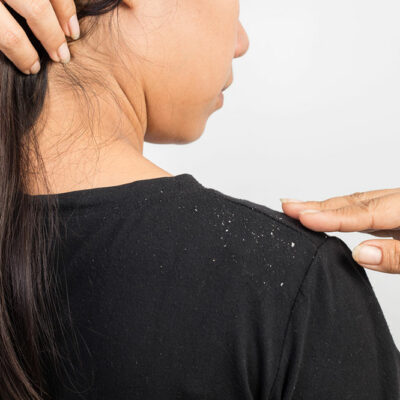 5 Home Remedies to Ward off Dandruff