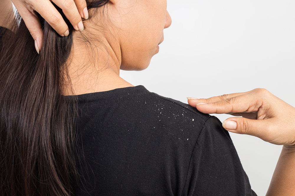 5 Home Remedies to Ward off Dandruff