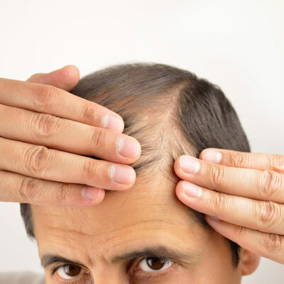 5 Trusted Products That Prevent Hair Loss