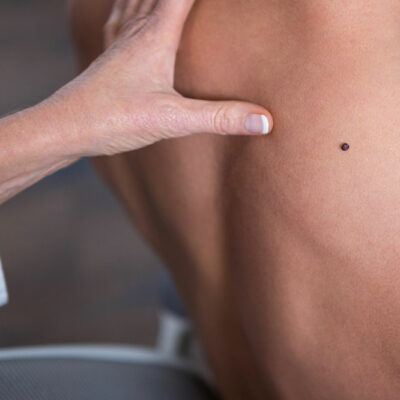 Early Warning Signs for Melanoma