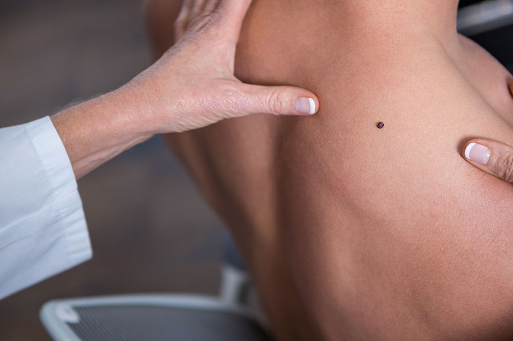 Early Warning Signs for Melanoma